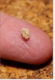 kidney stones